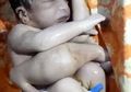 Bayi Kembar Parasit dengan Kaki dan Kelamin Ganda Ini Nyaris Dibuang ke Sungai, Kini Ia Sukses Menjalani Operasi