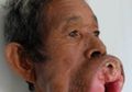 Selama 30 Tahun Alami Pembesaran Gusi, Pria Asal Kamboja Ini Akhirnya Sembuh Juga