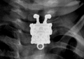 Dari Spongebob Sampai Ponsel, Inilah 7 Benda Aneh yang Pernah Bersarang di Tubuh Manusia yang Terdeteksi X-ray