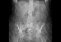 Terdeteksi X-ray, Inilah 7 Benda Aneh yang Pernah Bersarang di Tubuh Manusia, Salah Satunya Ada Gunting di Dalam Perut