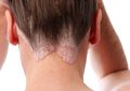 Hati-hati! Ketombe yang Sulit Hilang dan Kulit Kepala Bersisik Bisa Jadi Tanda Psoriasis