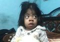 Kasihan, Gadis Cilik Ini Derita Hernia Tali Pusar yang Menggantung di Perut. Beratnya Mencapai 1 Kg