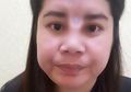 Operasi Bedah Hidungnya Gagal, Hal Mengerikan Terjadi pada Wajah Wanita Asal Thailand Ini