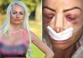 Pengakuan Seorang Wanita yang Terobsesi Menjadi Barbie di Dunia Nyata, 'Saya Membenci Hidung Saya Sejak Masih Remaja'