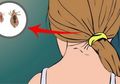 Jengkel dengan Kutu Rambut? Musnahkan dengan Bahan-bahan Alami Berikut