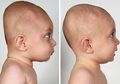 Wajib Tahu, Ini Sindrom Kepala Datar pada Bayi Serta Risikonya!