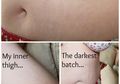 3 Tanda Mama akan Mengalami Stretch Mark Saat Hamil