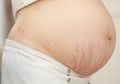 Cegah Stretch Marks Sejak Awal Kehamilan, Ini Caranya!