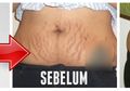 Heboh! Vicks Vaporub Cepat Atasi Stretch Marks Usai Melahirkan