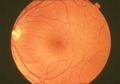 Pupil Mata Berubah Putih? Waspada Kanker Retina