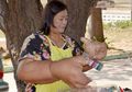 Penyakit Gigantisme Langka, Tangan Wanita Ini Membengkak Tak Terkira