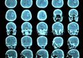 Mengenal Penyakit Mematikan, Meningitis