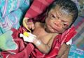 Sindrom Langka , Bayi Ini Lahir dengan Wajah Keriput Mirip Orang Tua