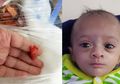 Perjuangan Hidup Manushi, Bayi Pematur yang Terlahir Sebesar Sebatang Coklat