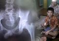 Ingat Akmal yang Lahirkan 21 Telur? Dokter: Hasil Uji Lab Membuktikan itu Telur Ayam!