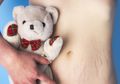 Ternyata Warna Merah dan Putih pada Stretch Mark Punya Arti Berbeda loh, Ini Penjelasannya!