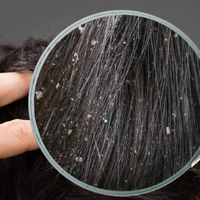 Coba Gunakan Ini pada Rambut Anda Bila Berketombe dan Lihat Hasilnya yang Mengejutkan!