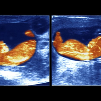 Bayi Kembar di Vietnam Ini Diketahui Memiliki Ayah Berbeda Setelah Menjalani Tes DNA
