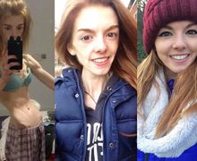 Gadis Ini Selamat dari Anoreksia Berkat Coklat, Begini Transformasi Tubuhnya Sekarang