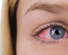 Mata Merah dan Berair Adalah Gejala Virus Corona yang Jarang Diketahui