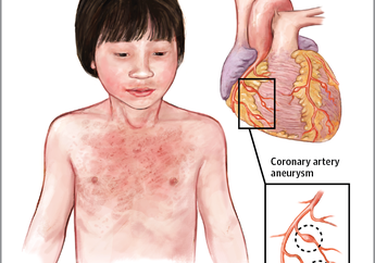 Anak-anak Ras Asia Berisiko Terkena Kawasaki Syndrome. Indonesia?