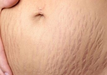 Bye-bye Stretch Mark!, Bahan Alami Ini Bikin Kulit Moms Mulus
