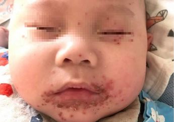 Akibat Sering Dicium Banyak Orang, Bayi Ini Menderita Herpes Simpleks
