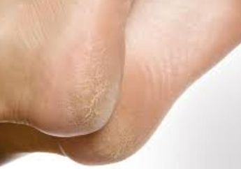 Efektif! Atasi Tumit Pecah-Pecah dengan Bahan-Bahan Alami Ini Moms
