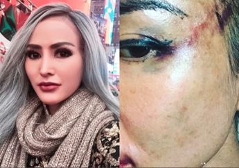 Dipukuli Pacar dan Tolak Tinggal Bareng, Begini Muka Cynthiara Alona Sekarang, Netizen: Mengerikan!