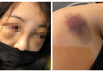 Gara-gara Mendengkur, Gadis 17 Tahun Jadi Korban Penganiayaan Temannya
