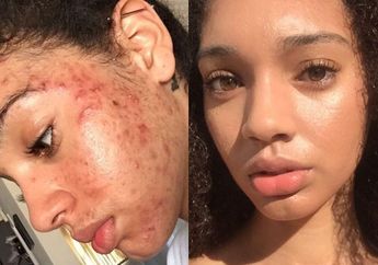 Perawatan Rumahan Hilangkan Beruntusan dari Model Amerika, Mudah!