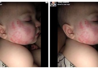 Titip Anak di Tempat Penitipan Anak, Seorang Ibu Kaget Setelah Lihat Wajah Anaknya Penuh Gigitan