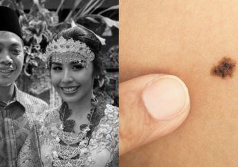 Kanker Kulit Renggut Nyawa Adara Taista Menantu Hatta Rajasa, Cara Sederhana Ini Ampuh Cegah Kanker Kulit