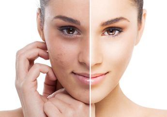 Cara Ampuh Atasi Flek Hitam Dengan kombinasi Bahan Alami, Bye-Bye Flek Hitam!