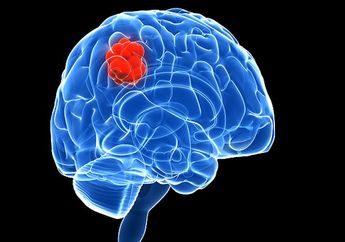 Ini Dia Hal Penting Yang Perlu Kita Tahu Tentang Tumor Otak