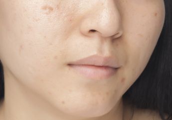 3 Serum Niacinamide Terbaik Buat Hilangkan Bekas Jerawat yang Hitam!