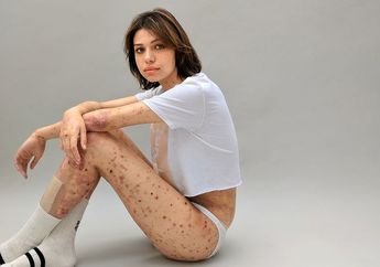 Meski Alami Kelainan Gen, Gadis Ini Tetap Percaya Diri Jadi Model