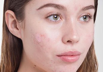 Super Ampuh, Basmi Jerawat Bruntusan Pakai 3 Masker Terbaik Harga Terjangkau Ini!