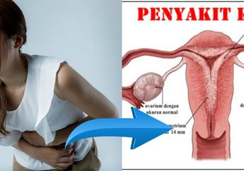 Kista, Gangguan Kesehatan Wanita yang Bisa Menjadi Kanker di Rahim