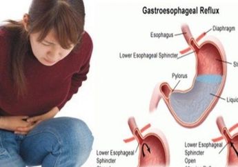Pernah Merasakan Sensasi Makanan Tersangut di Tenggorokan? Bisa Jadi Anda Alami Gejala Asam Lambung Tinggi