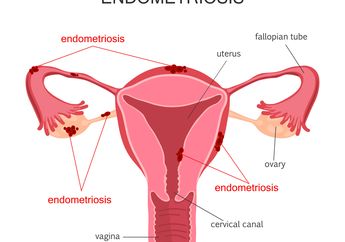 Endometriosis Penyakit Wanita, Gejalanya Bisa Sakit di Anus Saat BAB