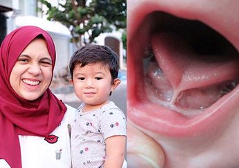 Putra Nycta Gina Alami Kelainan Bibir dan Lidah Hingga Tak Bisa Menyusu, Operasi Jadi Jalan Keluarnya