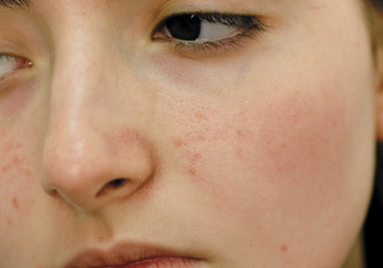 5 Penyebab Munculnya Noda dan Bintik-Bintik di Wajah. Enggak Flawless!