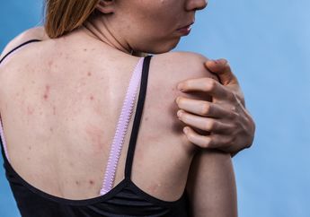 6 Cara Menghilangkan Bisul Secara Alami dan Cepat, Pasti Sembuh