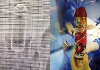 Pria ini Jalani Operasi Darurat Setelah Semprotan Penyegar Udara Terjebak di Dalam Bokongnya, Kok Bisa?