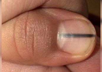 Perhatikan Baik-baik, Apakah Anda Melihat 12 Tanda Ini di Tubuh Anda? Segera Hubungi Dokter, Bisa Jadi Itu Gejala Kesehatan Serius