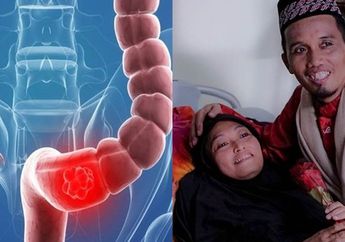 Idap Kanker Usus Selama 7 Tahun dan Baru Terdeteksi 4 Bulan Sebelum Meninggal, Ketahui Tahapan Stadium Kanker Usus!