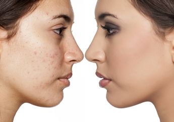 Tips Jitu Mencegah Bruntusan di Dahi. Harus Rajin Cuci Muka!