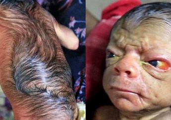 Alami Benjamin Button Disease, Bayi Ini Bikin Geger Ruang Operasi Pasca Kelahirannya