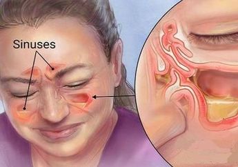 Jangan Abaikan Sinusitis di Masa Pandemi Covid-19, 5 Komplikasi Ini Bisa Saja Terjadi